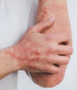 Eczema Psoriasis Zona